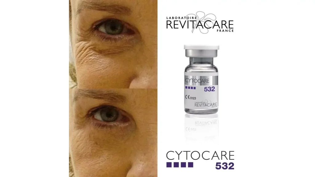 A before and after photo of a Cytocare-treated patient for their under-eye region.