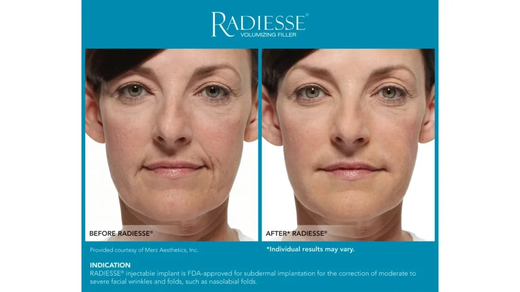 A Radiesse-treated patient's before and after photo of their treatment to improve their aging skin.