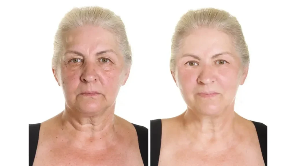 A patient received a Nucleofill treatment for their face and neck regions.