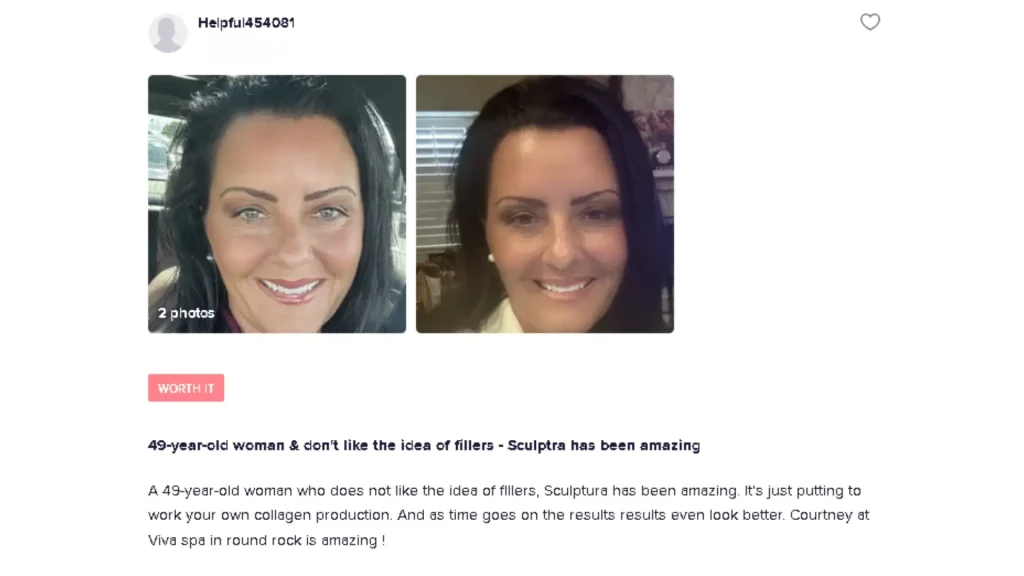 A patient's review on RealSelf about their satisfaction with Sculptra treatments.