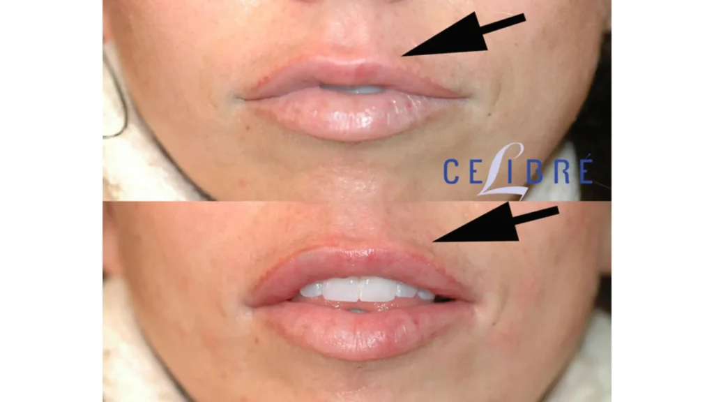 A Restylane-treated patient's before and after photo of their symmetrical lips post-treatment.