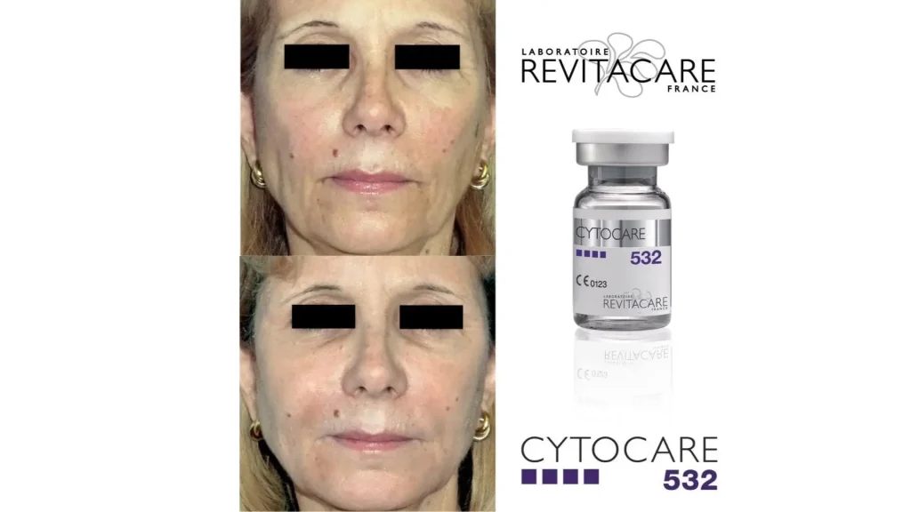 A Cytocare-treated patient's before and after photo of their facial treatment.