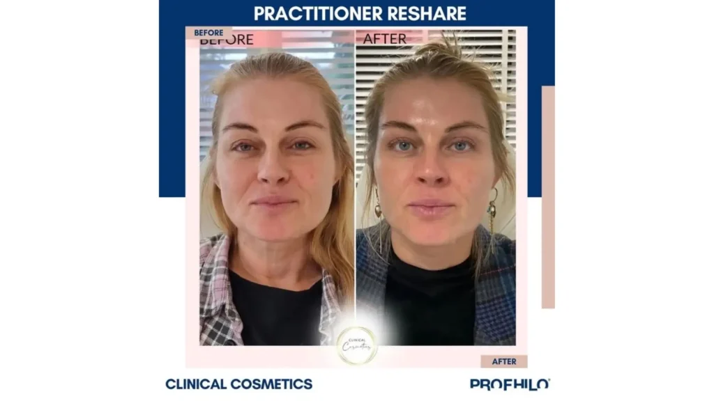 A Profhilo-treated patient's before and after photo of their facial injection treatment.