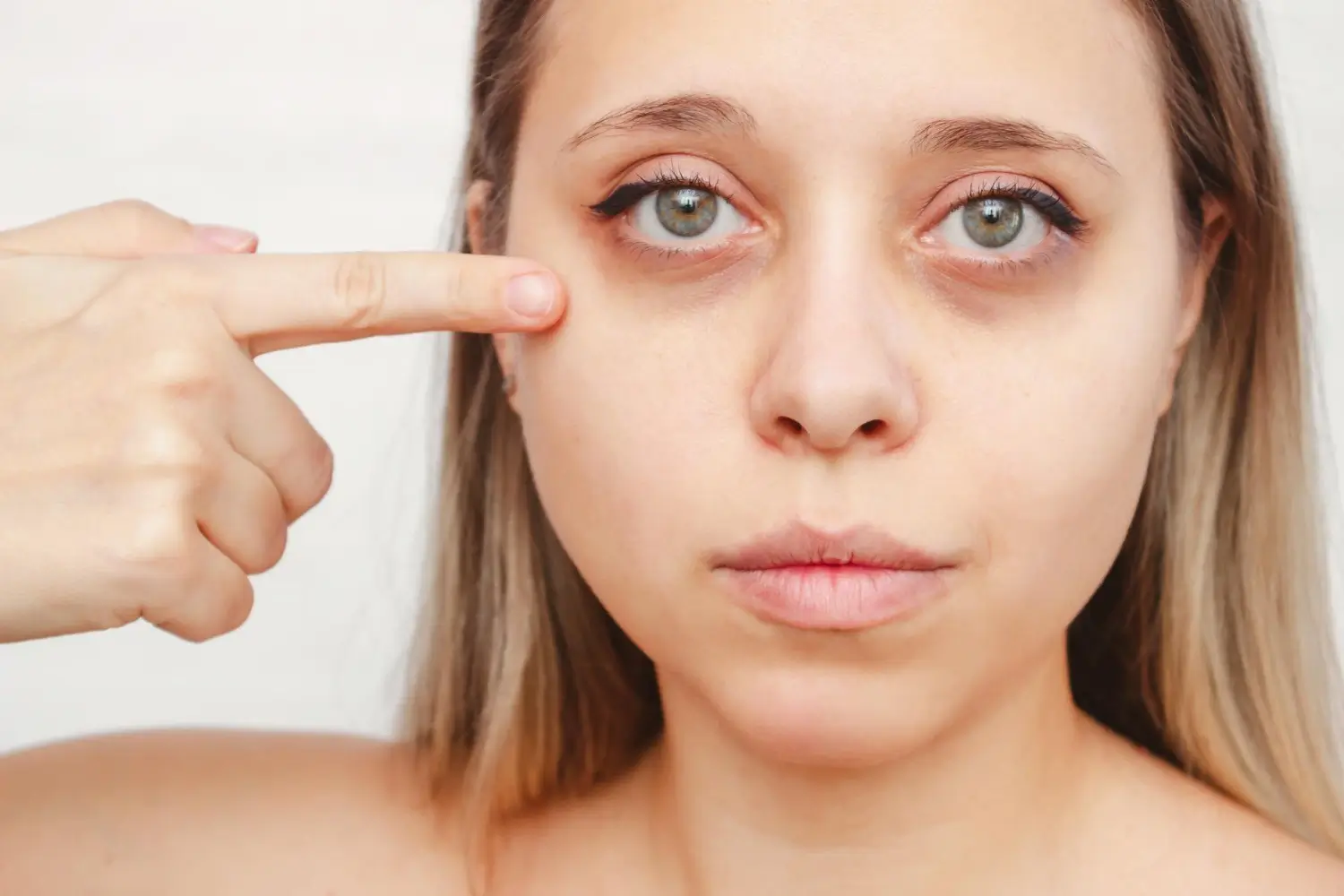 An individual with eyebags and dark circles under the eyes.