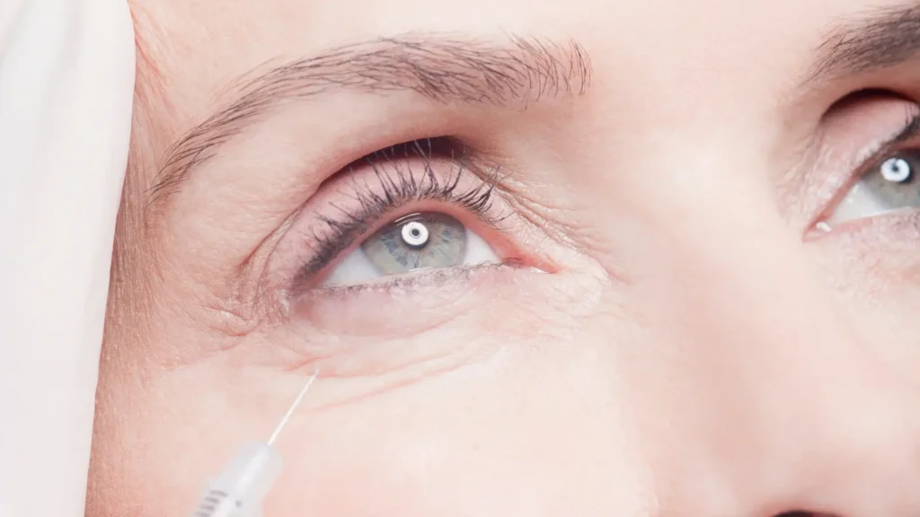 A close-up shot of an injection into the under-eye region with an ultrafine needle.