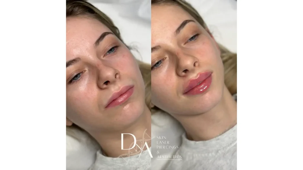 A patient's before and after photo of their Hyafilia lip filler treatment.