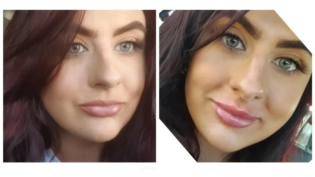 A Stylage-treated patient's before and after photo showing off their plumper and symmetrical lips.