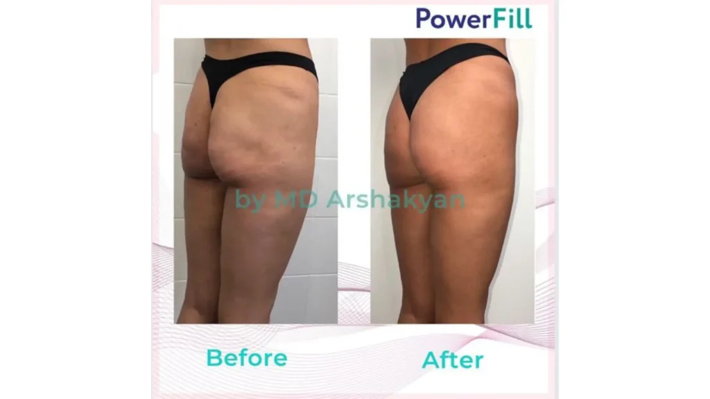A patient's before and after photo of their Powerfill treatment for buttocks.