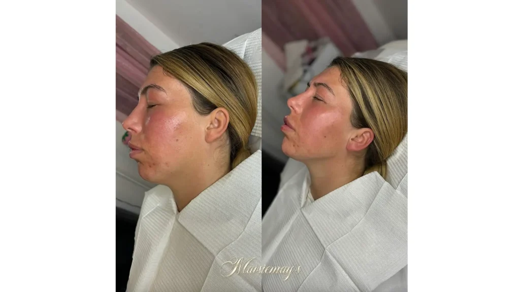 A patient's before and after photos of their cheeks, chin, jaw, and lips treatment with Hyafilia.