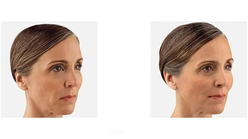 A patient's before and after photo of their volumized cheeks area for a youthful-looking appearance.