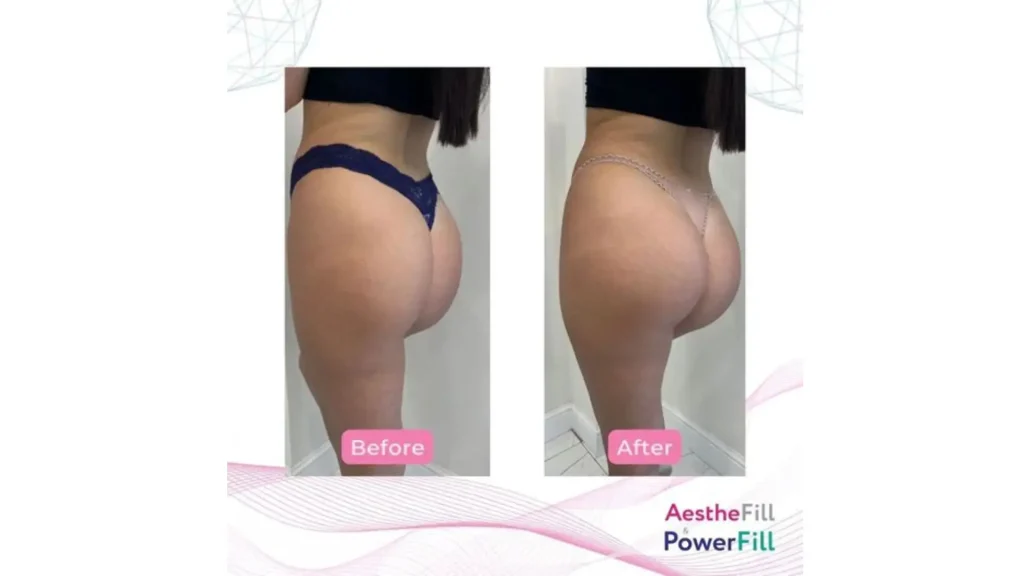 A patient's before and after photo of their Powerfill and Aesthefill treatment for buttocks.