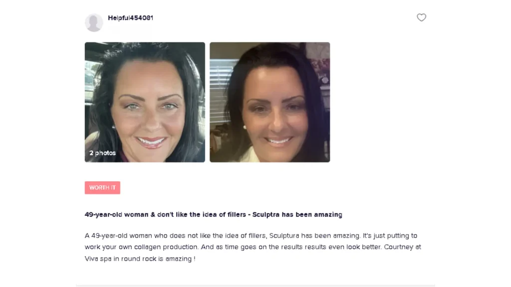 A Sculptra-treated patient’s testimonial on the impressive outcomes of the injectable.
