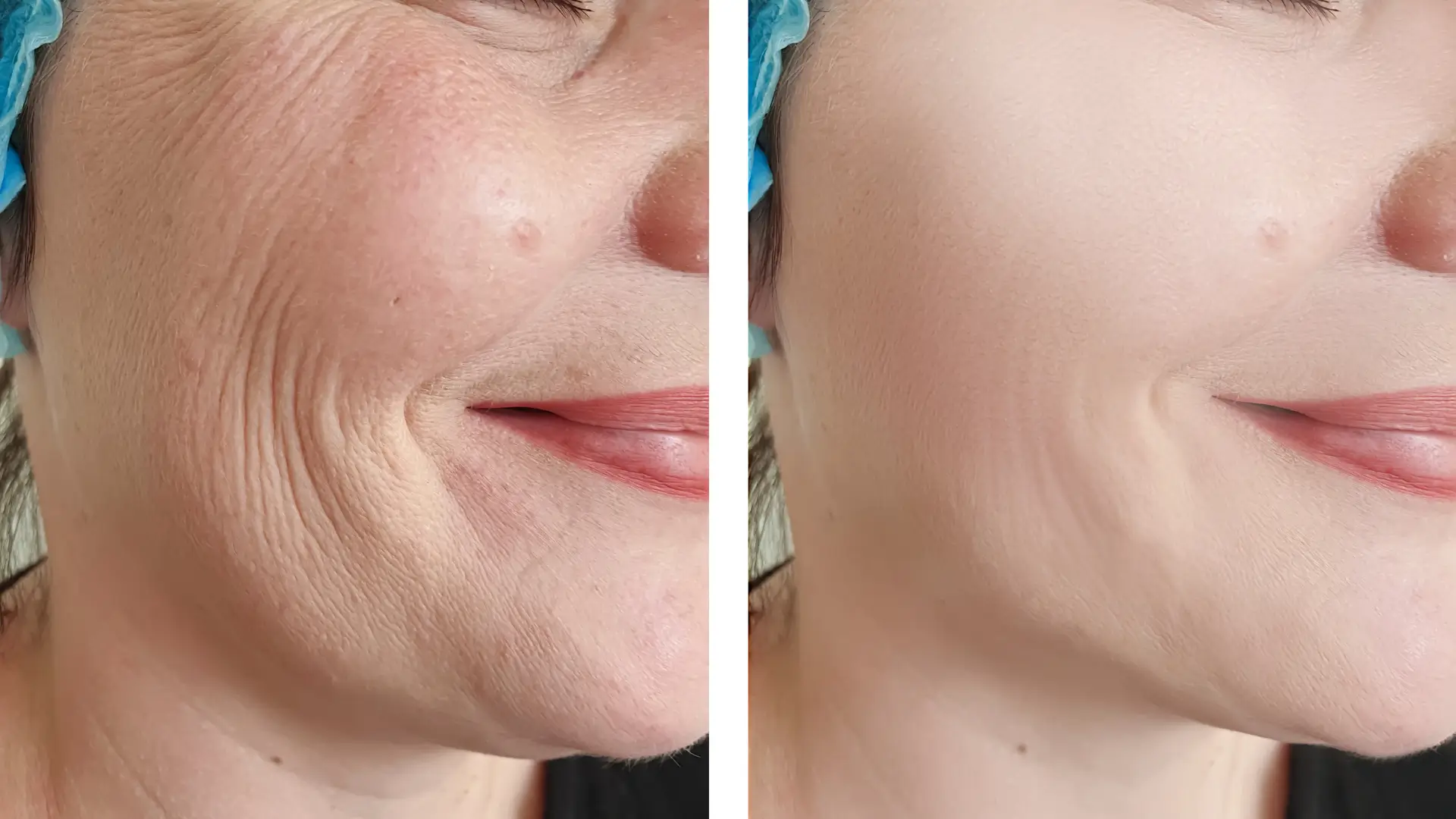 A patient's before and after photo to reduce their facial wrinkles and lines.