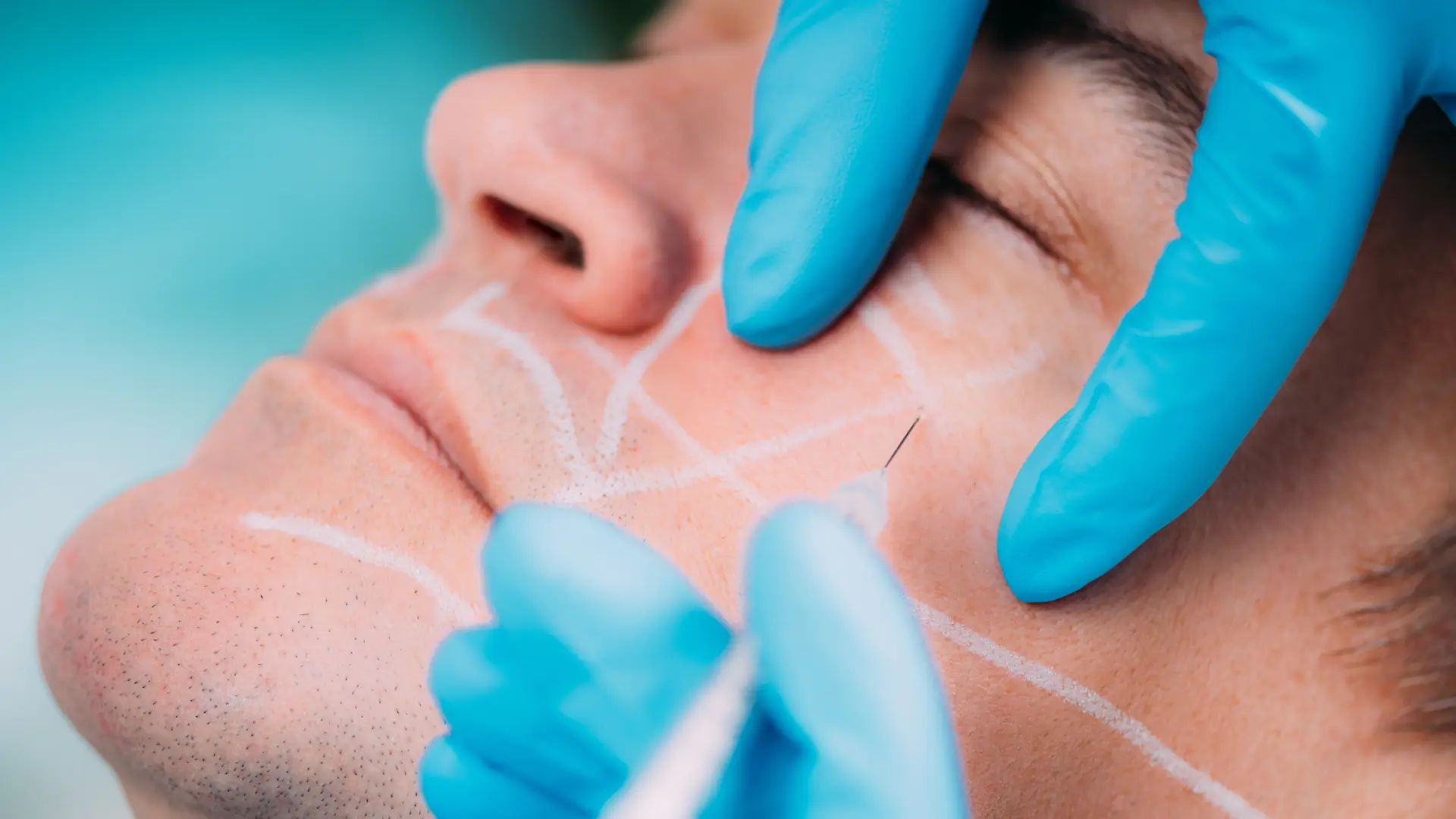 An individual receiving an injection in their midface region.