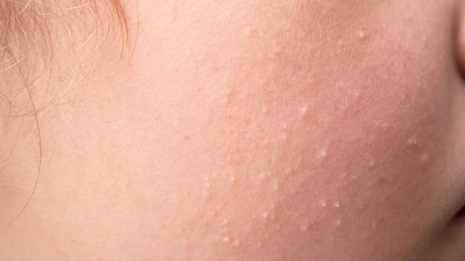 An individual suffering from lumps in their midface.