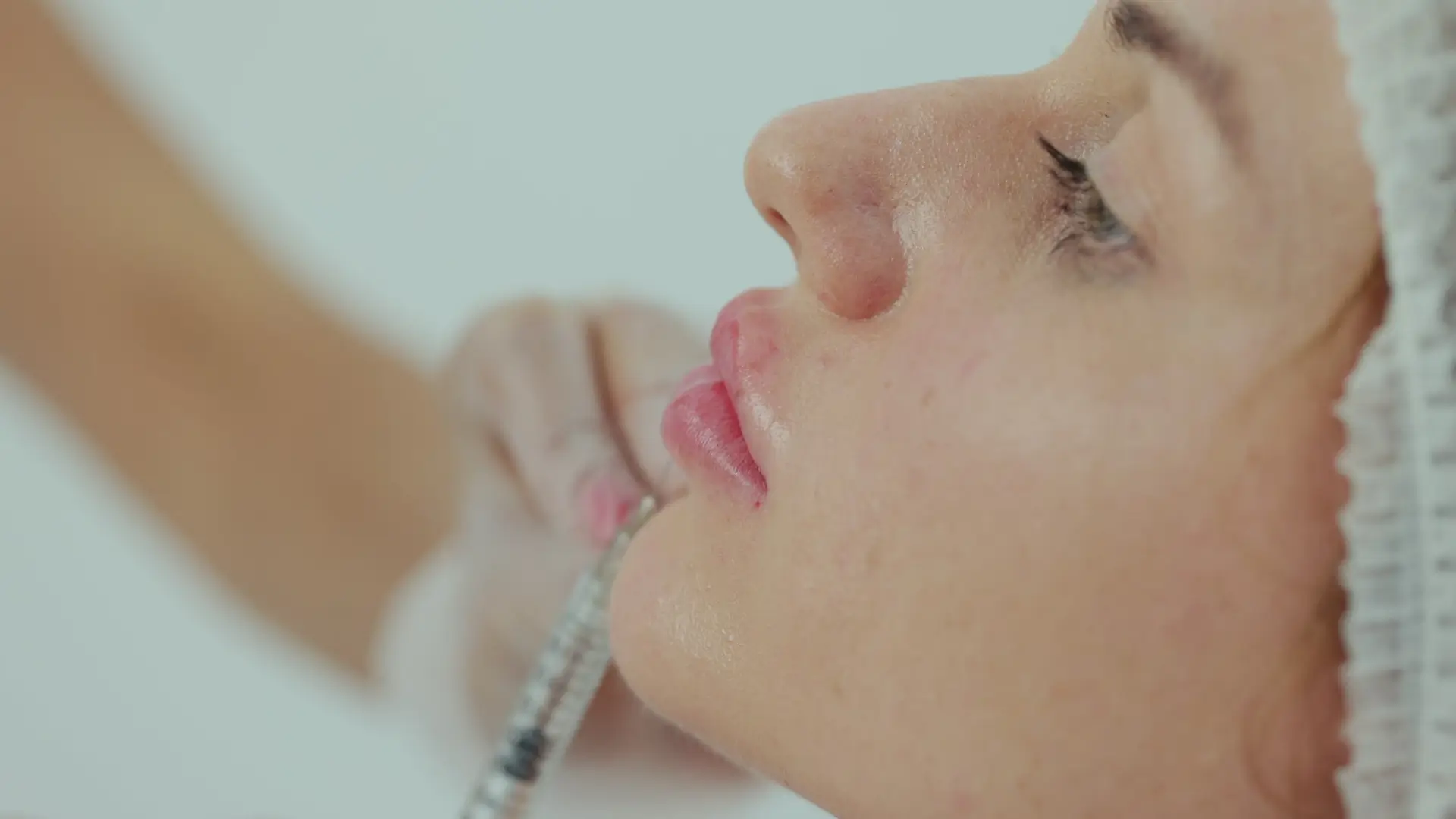 A patient receiving a filler injection for their lips.