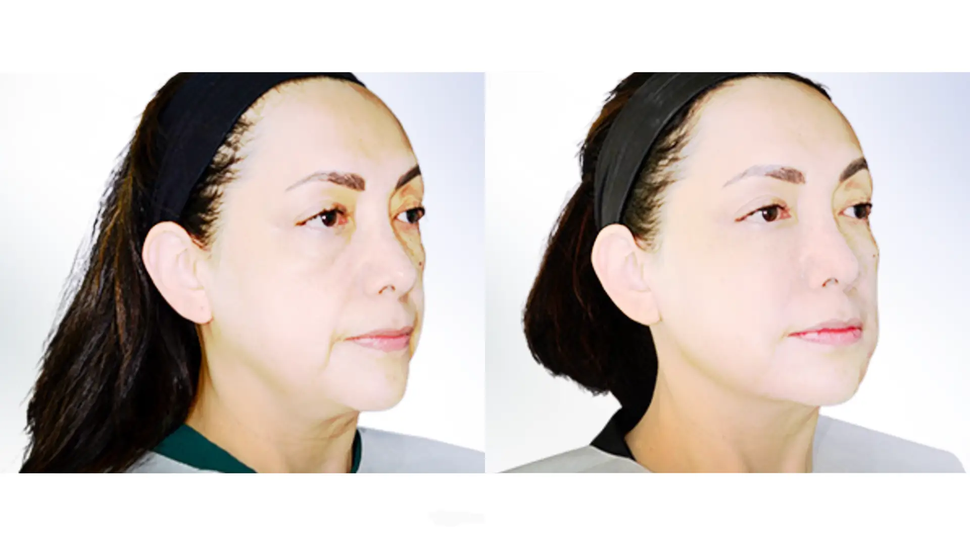 A Silhouette Threads-treated patient's before and after photo of their midface treatment.