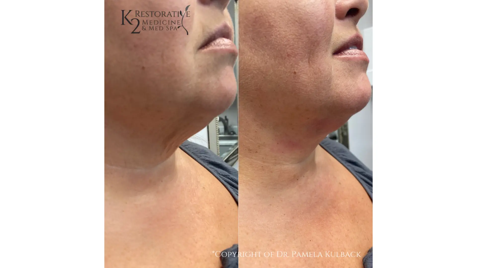 A patient's before and after photo of their PDO threads neck procedure.