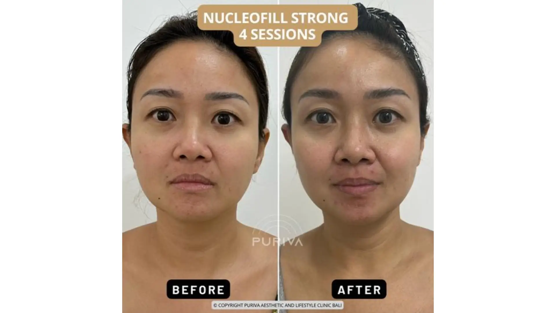 A patient's before and after photo of their Nucleofill polynucleotide treatment.