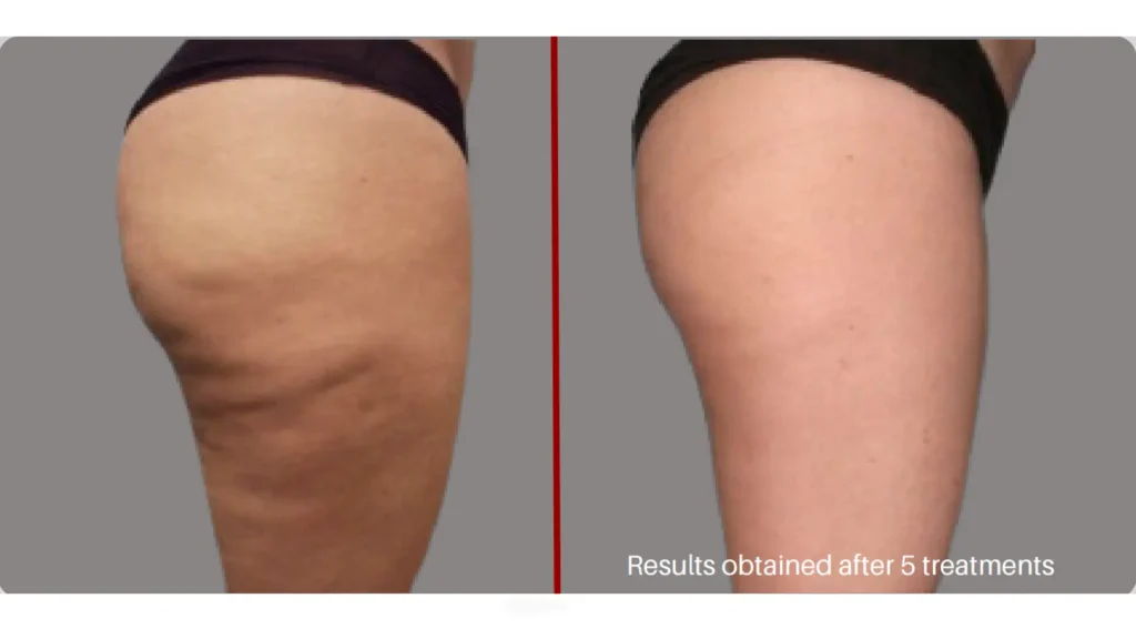 A patient's Alidya cellulite before and after photos on their thighs.