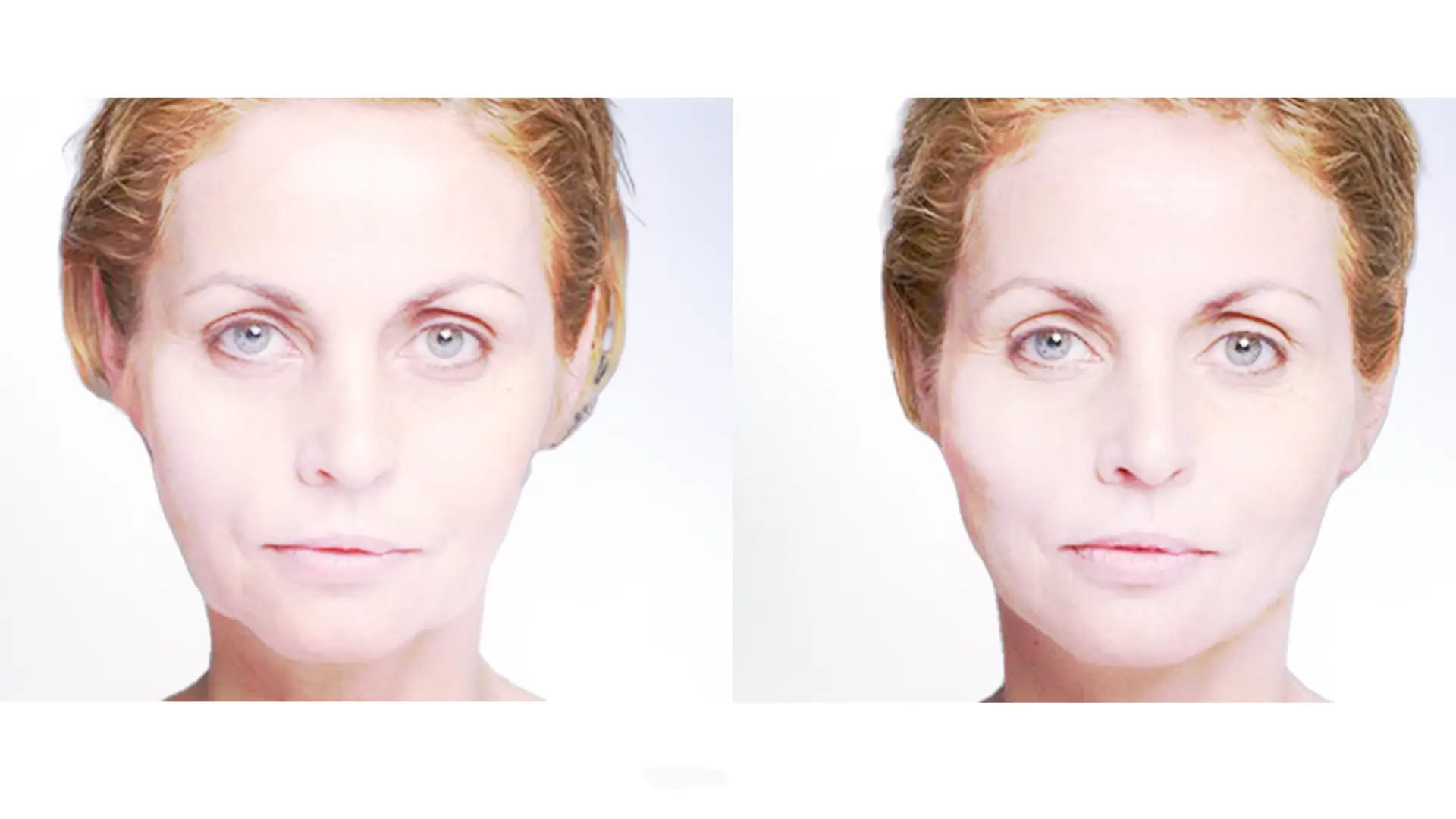A Silhouette Threads patient's before and after photo of their midface treatment and redefined jawline.