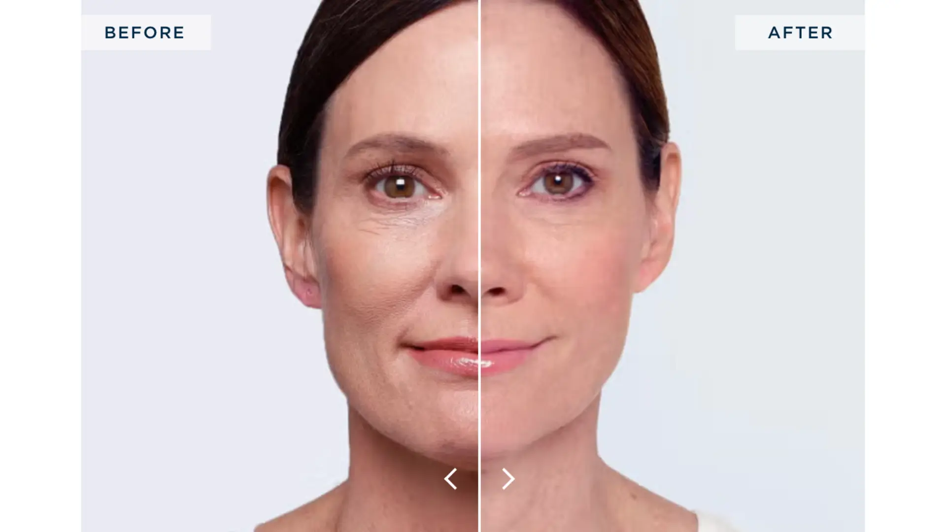 A Restylane-treated patient's before and after photo of their nasolabial fold treatment.
