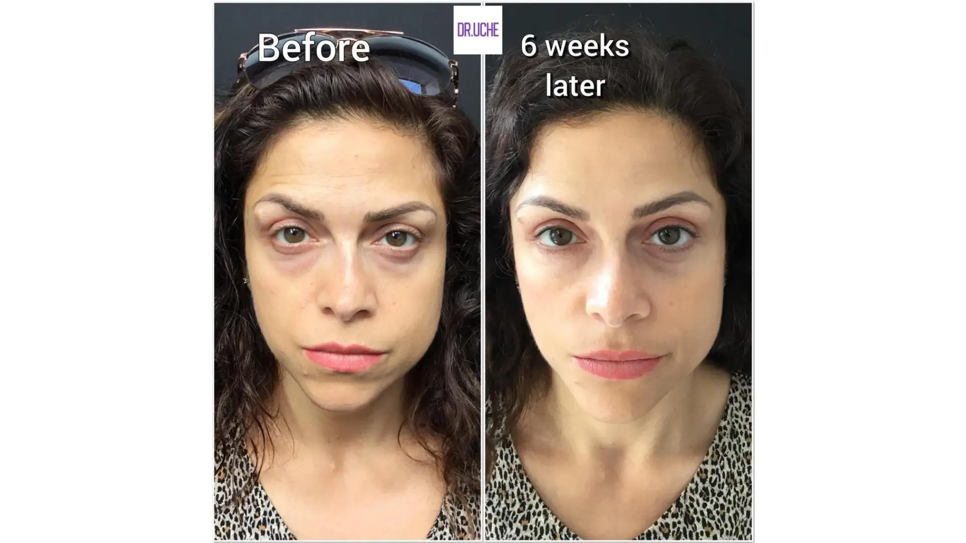 A patient's before and after photo of their facial improvements with polynucleotides.