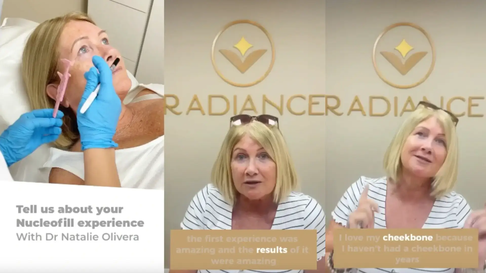 A patient's experience of their Nucleofill treatment for their cheekbones.