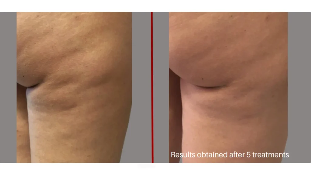 A patient's before and after Alidya cellulite treatment on their buttocks.