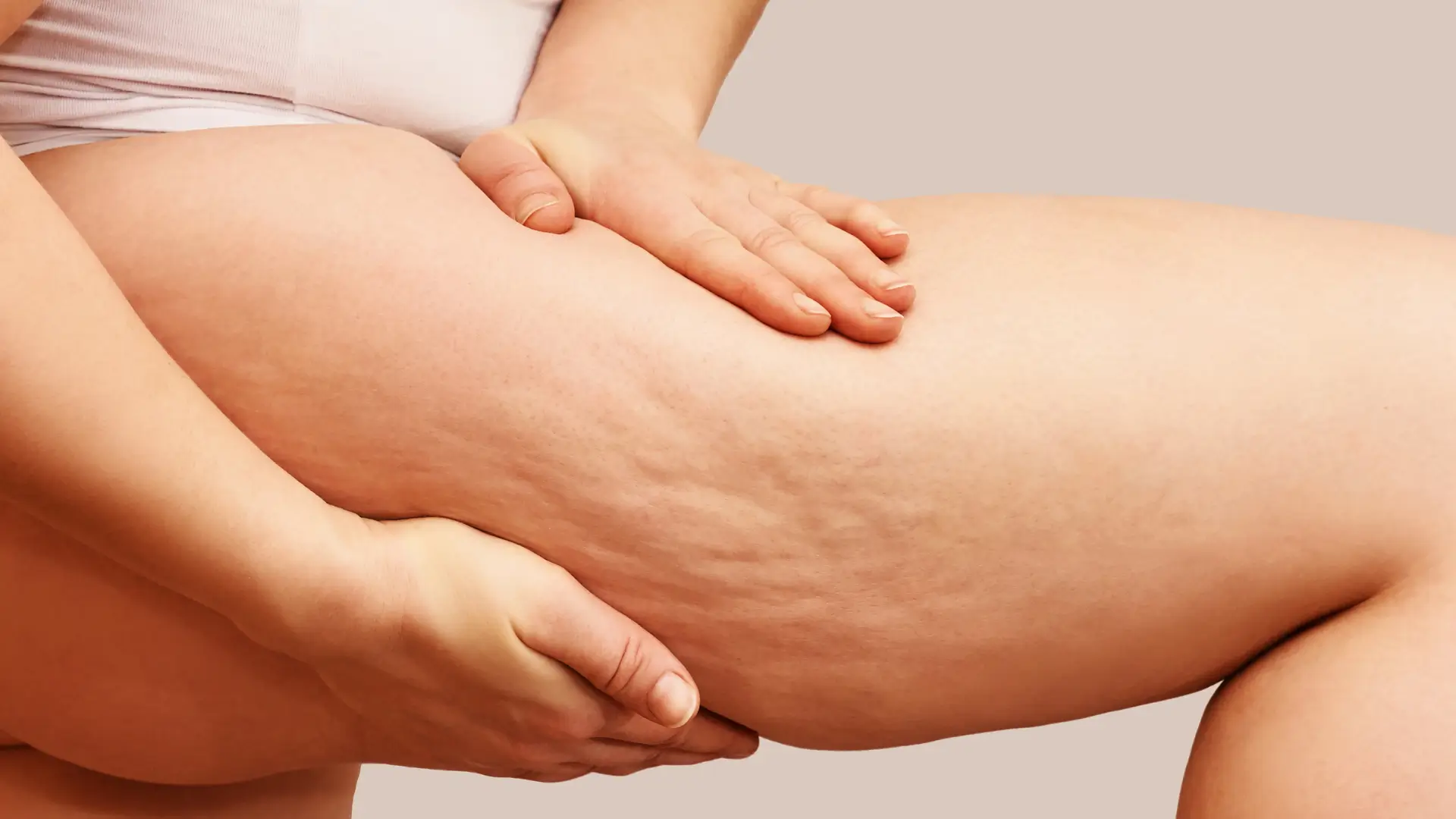 An individual showing their cellulite in their thigh.