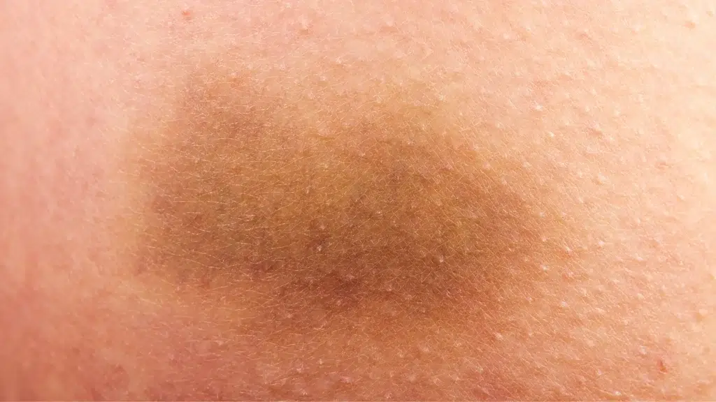 A close-up shot of a skin's bruising.