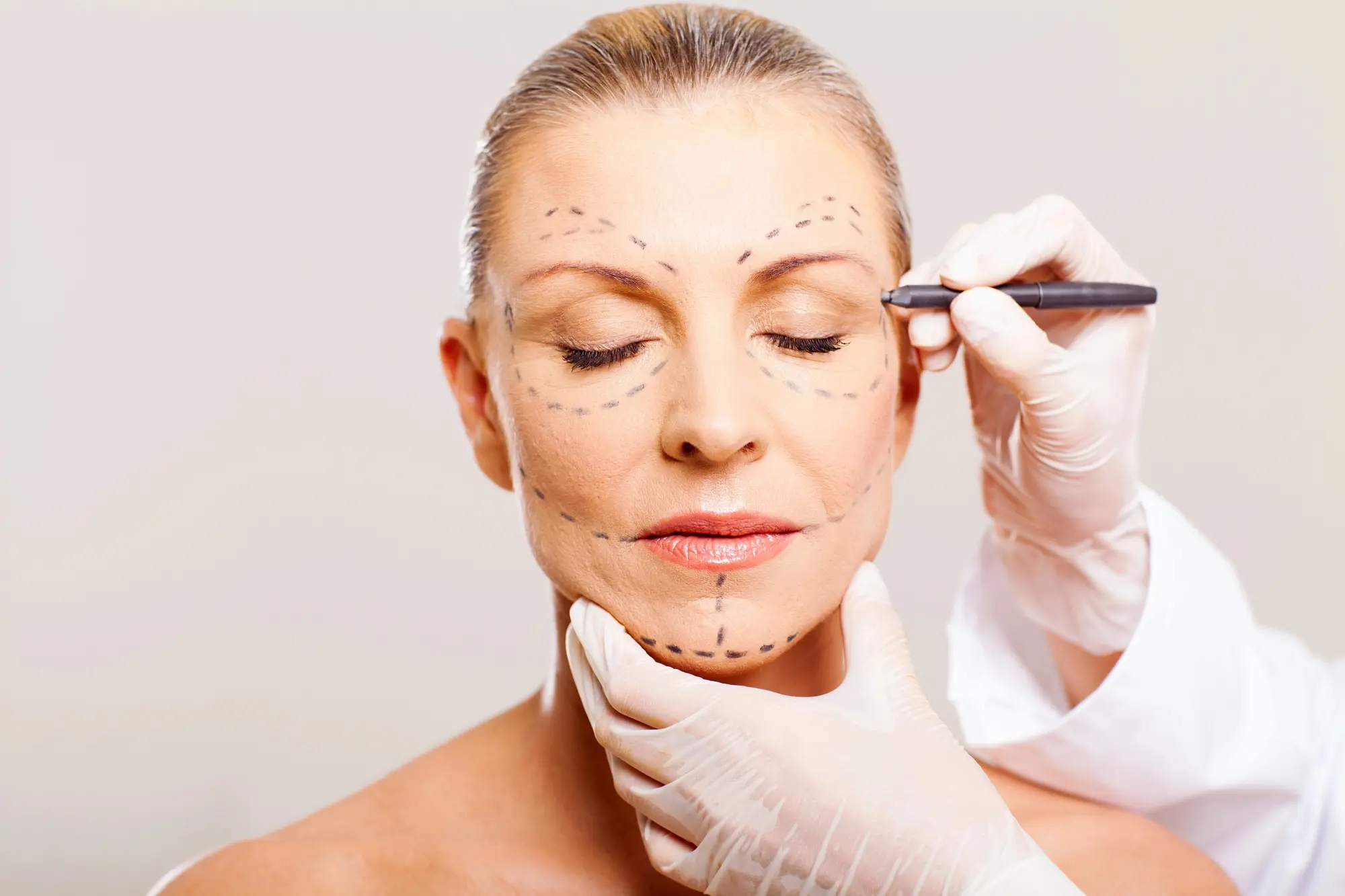 Close-up of a female patient's face during medical assessment for aesthetics treatment. Doctor's hands in white gloves are drawing the treatment guidelines on the patient's face.