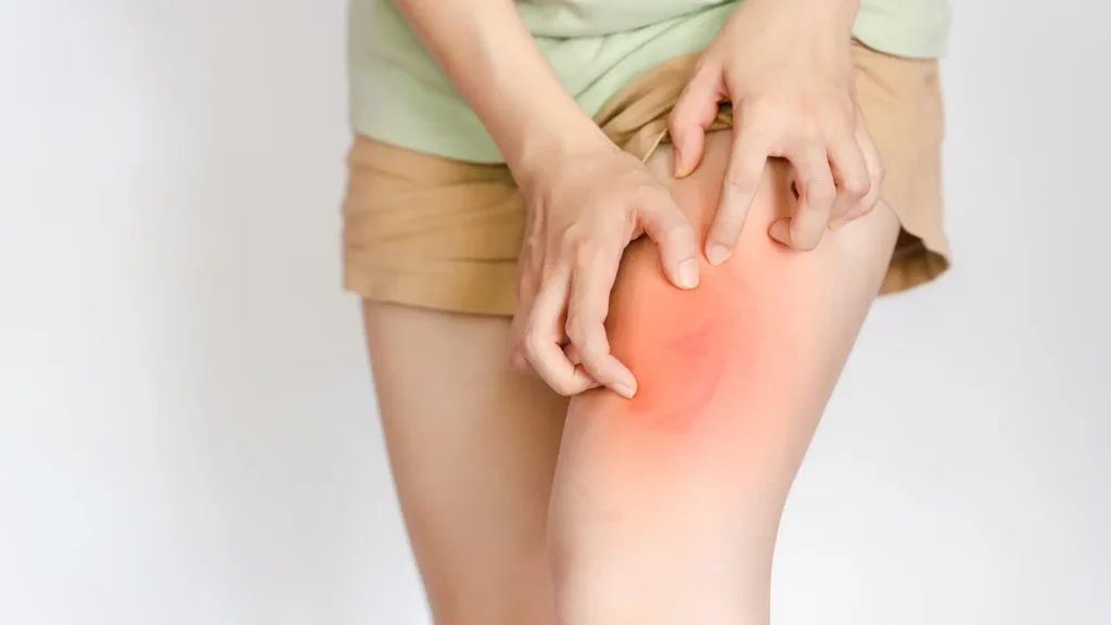 An individual suffering from an allergic reaction in the thighs.