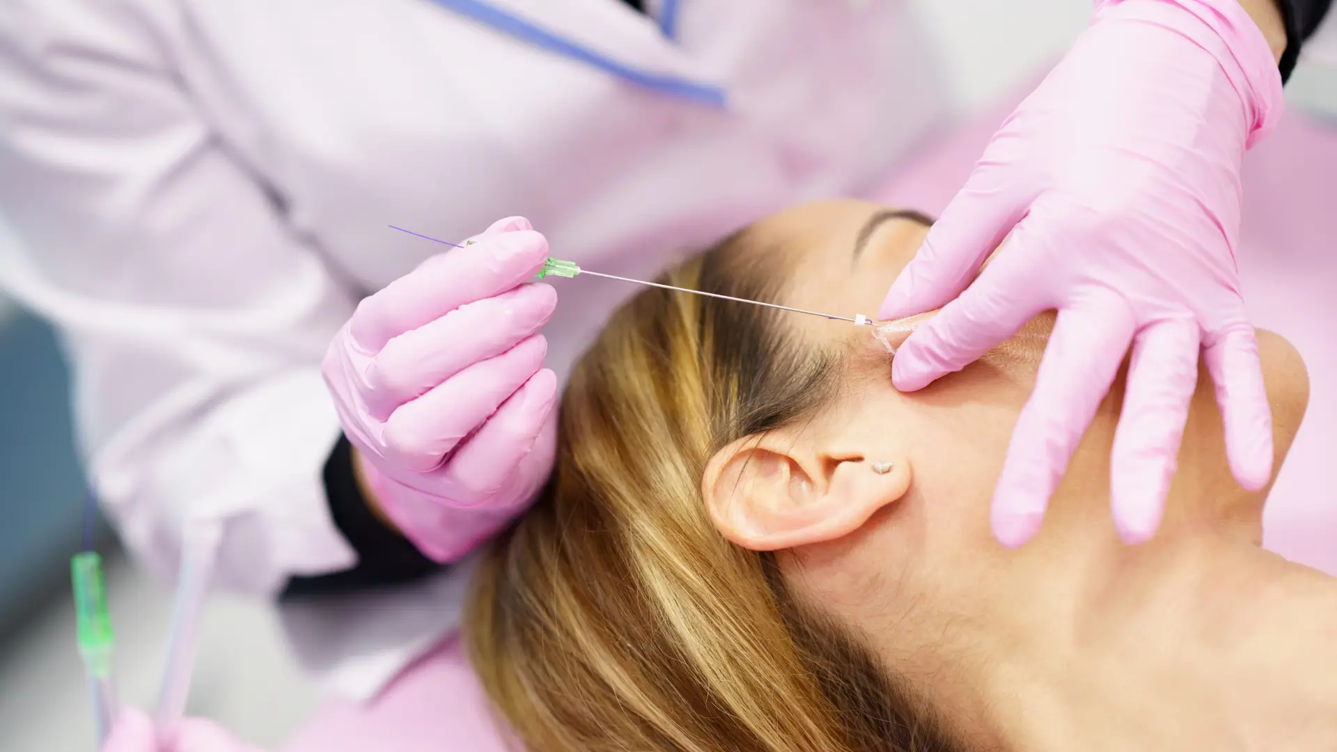A patient undergoing a thread lift procedure.