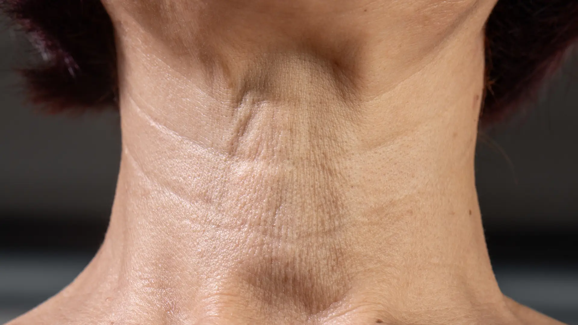 An older individual dealing with sagging skin in the neck rejuvenation.