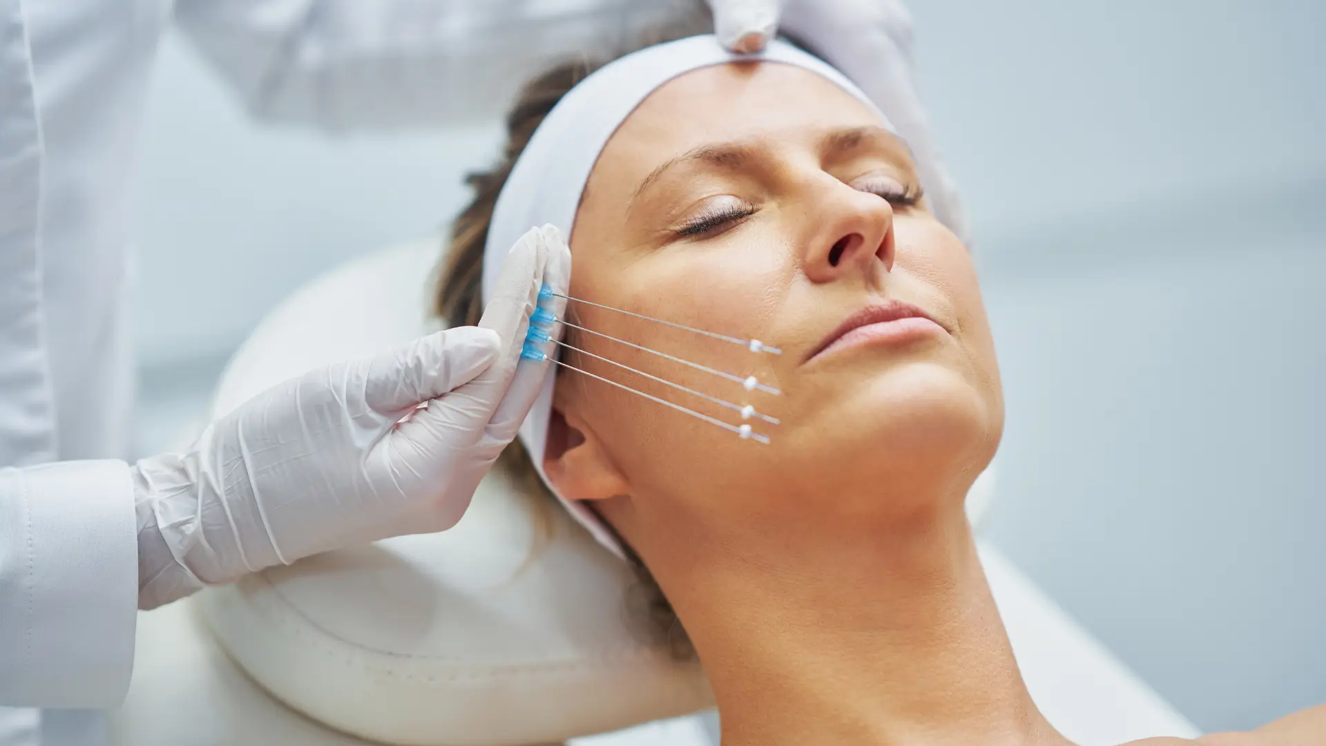 A medical professional administering a thread lift treatment.