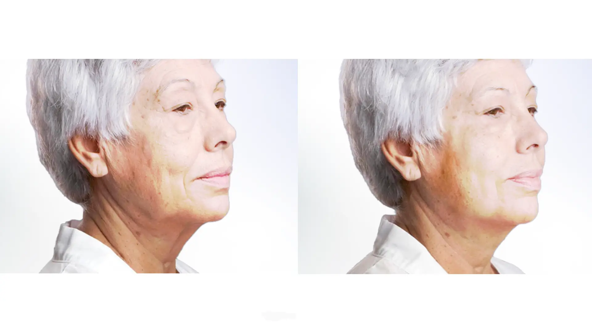 A patient's before and after photo of their Silhouette Threads treatment for midface and jawline contouring.