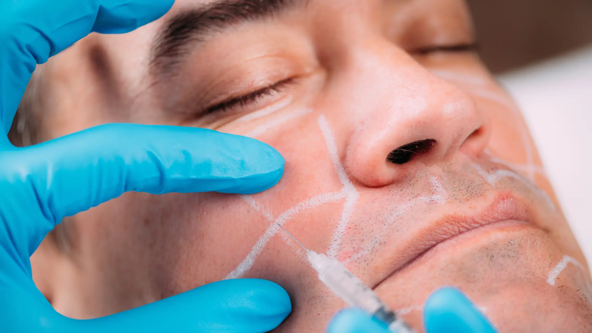 A medical provider administering an injection for the patient's cheeks.