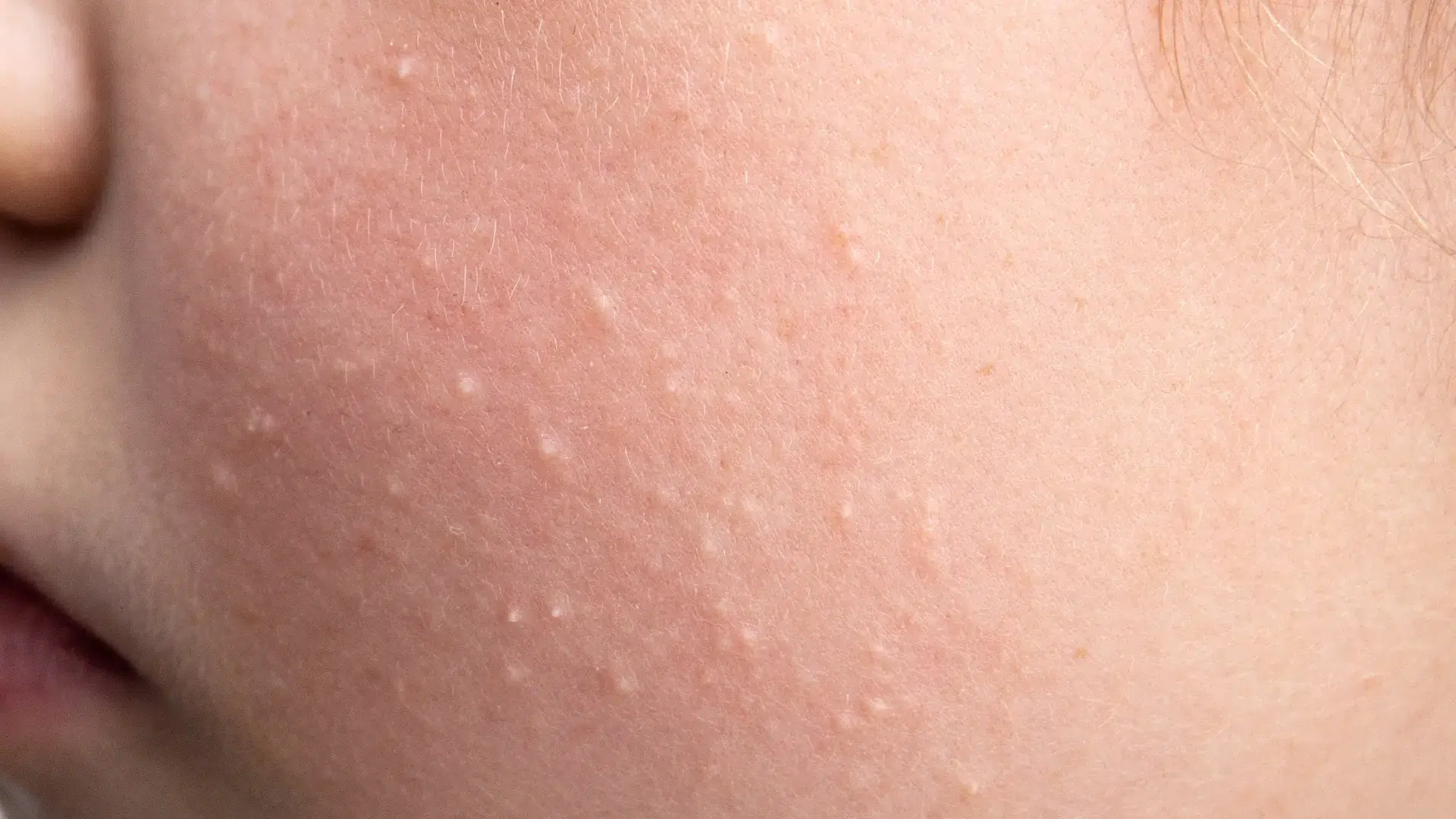 An individual suffering from nodules or bumps in their cheek area.