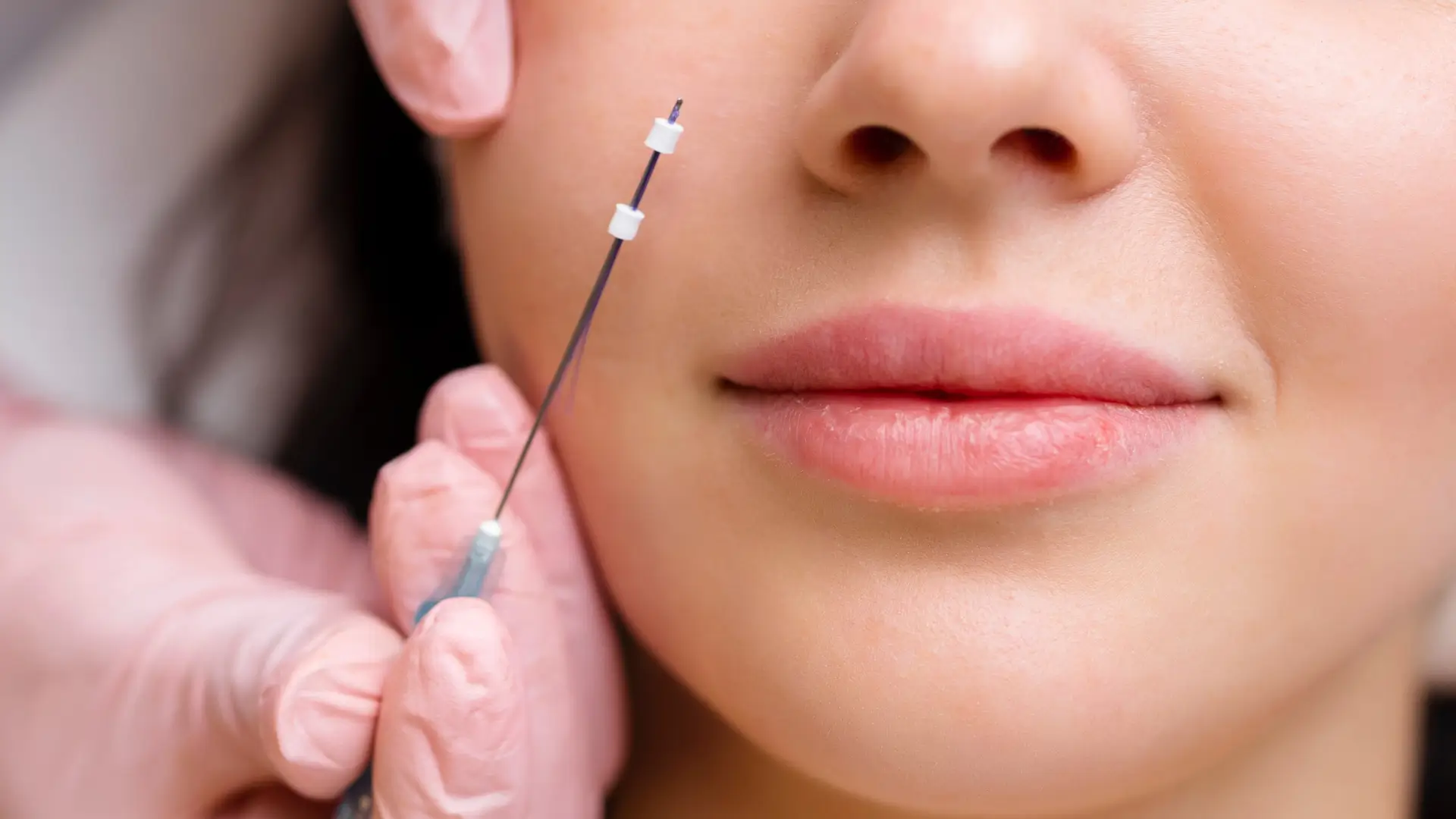 A medical practitioner preparing for a thread lift procedure.