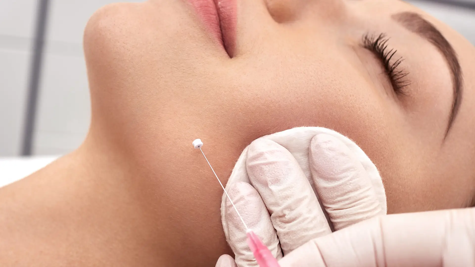 An individual receiving a thread lift treatment.