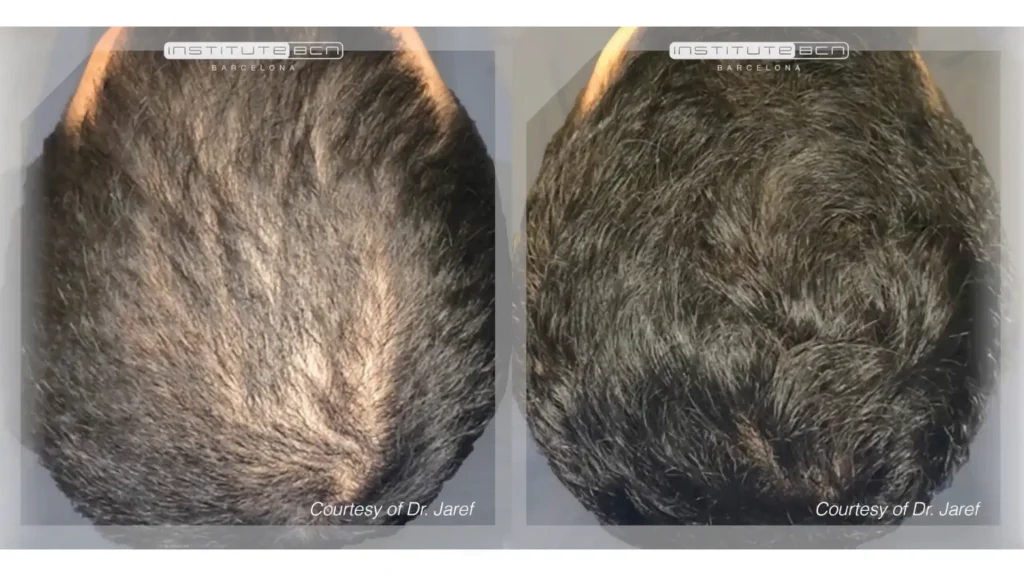A patient's before and after photo of their hair mesotherapy treatment with BCN Capillum Peptides.