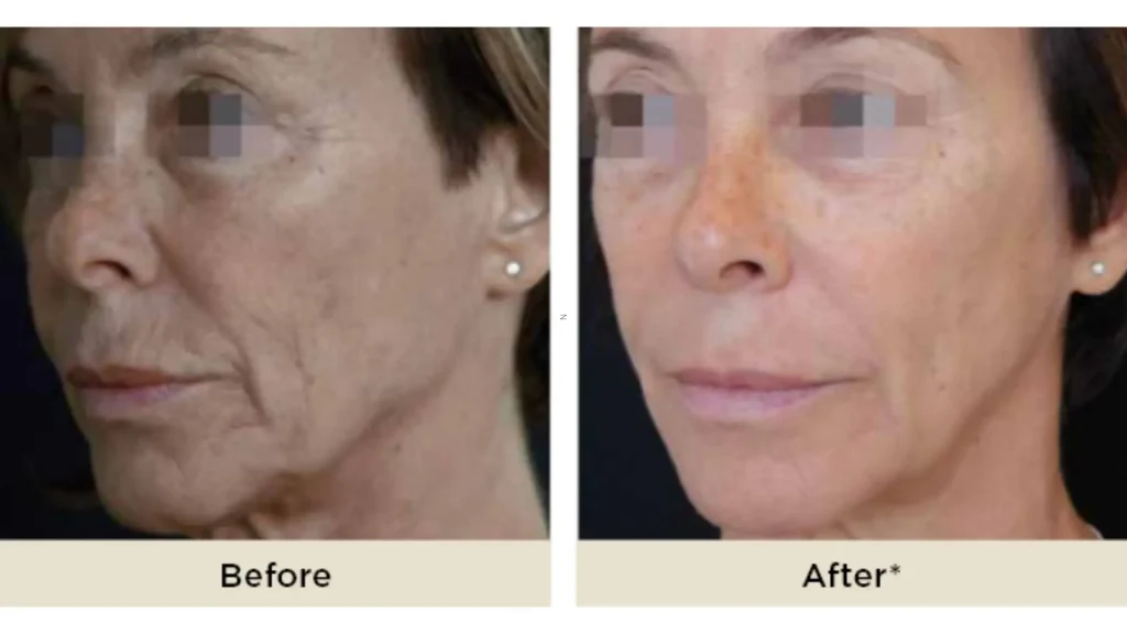 A patient's before and after photo of their midface improvement using Aliaxin.