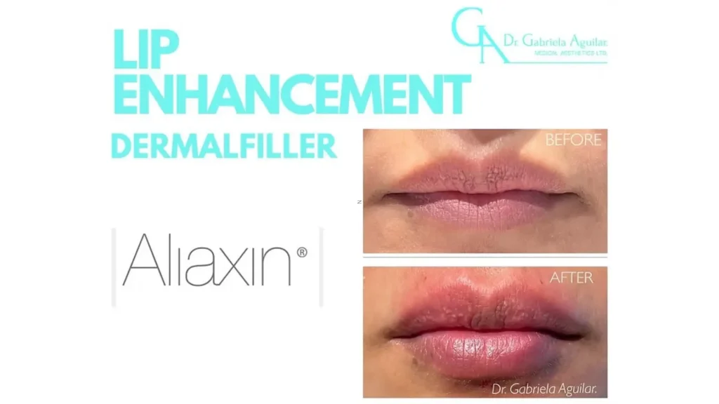 A patient's before and after photo of their Aliaxin lip enhancement treatment.