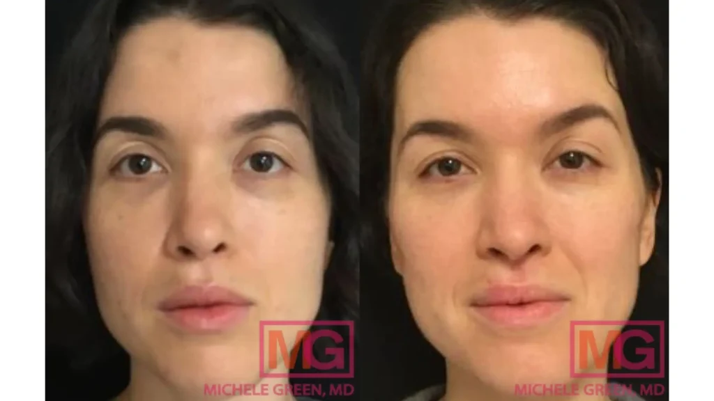 A patient's before and after photo of their Restylane treatment for their under eye.