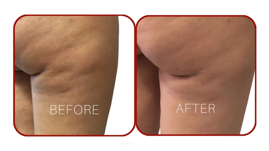 A patient's before and after photo of ther Alidya treatment for the back of their thighs.