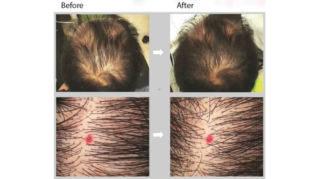 A patient's before and after photo of their Dr CYJ hair filler treatment for their thinning hair.