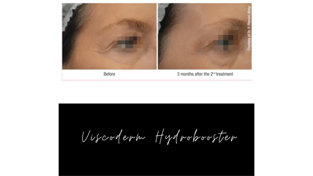 A patient's before and after photo of their Viscoderm Hydrobooster treatment for their eye region.