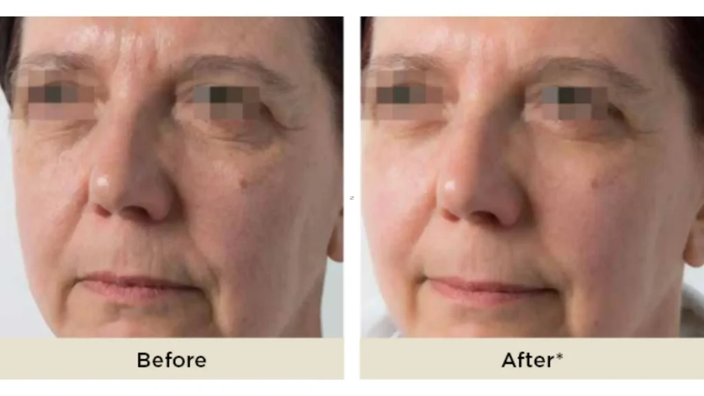 An individual's before and after photos of their Aliaxin facial treatment.