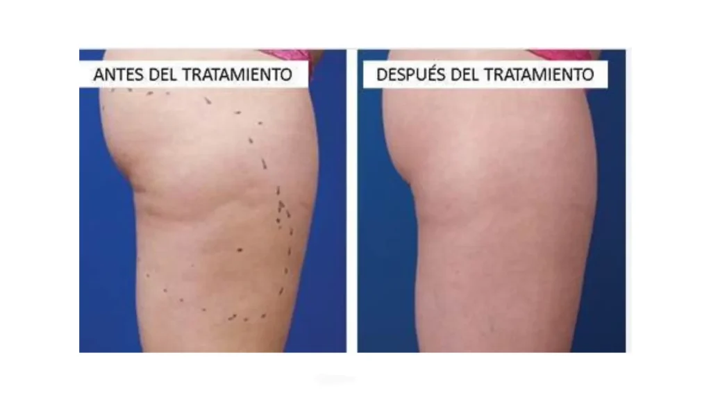A patient's before and after photo of their Alidya cellulite treatment.